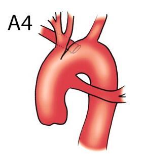 By Van Praaghs By Collett and Edwards Rarely Common trunk Aortopulmonary Pulmonary arteries collateral Left arteries + Right Pulmonary atresia with ventricular septal