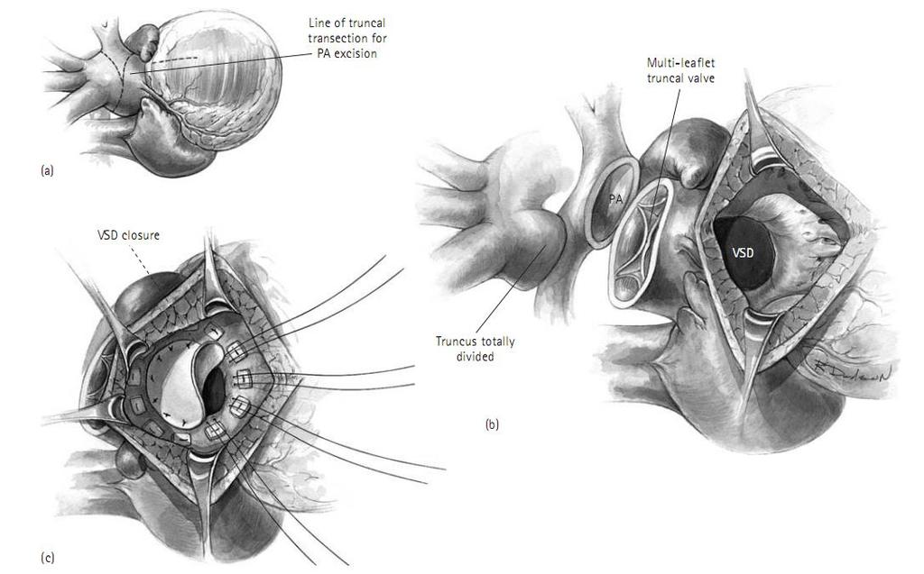 A. Excision of pulmonary