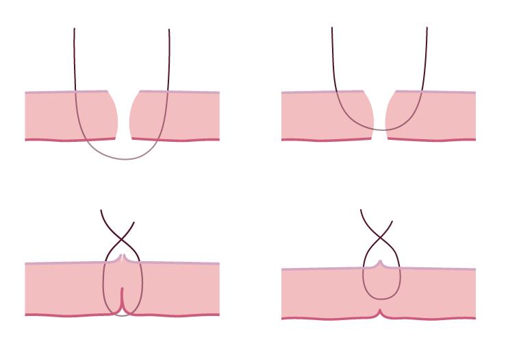 Khâu màng rụng sẽ dẫn đến khiếm khuyết khi lành tử cung 1 Đối với thành tư cung dày, khâu màn rụng có thê tạo sẹo xấu Decidua Included Decidua Excluded Khâu màng rụng có thể làm tử cung lành không