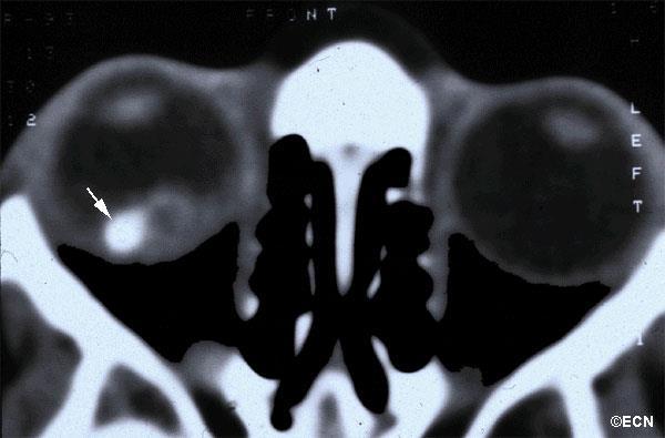 Tuy nhiên, MRI không hiệu quả để phát hiện can xi trong những trường hợp khó chẩn đoán. Hình 6.