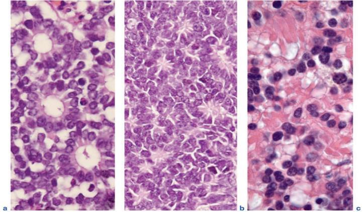 Hình 12. Đặc điểm mô bệnh học của u nguyên bào võng mạc (a) Hình ảnh hoa hồng Flexner-Wintersteiner.