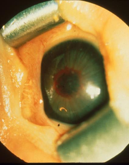 Hình 9. Tân mạch bờ đồng tử, giãn mạch máu mống mắt - Rush disease là một thuật ngữ mô tả BVMTĐN ở vùng I kèm theo bệnh cộng.