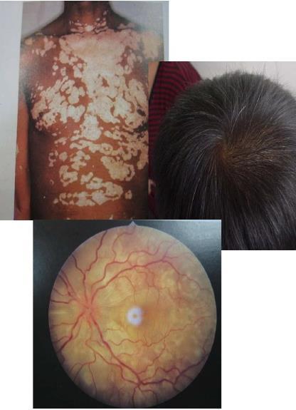 Hình 6: Hội chứng Vogt - Koyanagi Harada (Nguồn: http://www.slideshare.