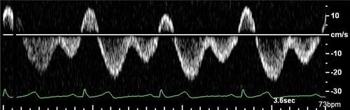 Hình 7 Ảnh hưởng của các yếu tố bệnh nhân lên sự biểu hiện của dạng sóng phổ Doppler. Bốn dạng sóng phổ Doppler thu được từ cùng một tình nguyện viên trẻ khỏe trong khoảng 5 phút.