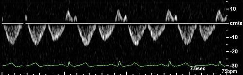 Các dạng sóng xuất hiện bình thường trong khi thở yên tĩnh (c) và khi chủ thể ngưng thở ở cuối thì hít vào (d). Lưu ý các biến thể phổ sóng C bình thường ở cuối thì hít vào.