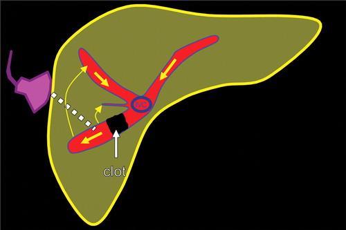 Figure 9 Reversed flow in the hepatic vein due to obstruction. Hình 9 Dòng đảo ngược ở tĩnh mạch gan do tắc nghẽn. (a) Diagram shows a clot in the right hepatic vein.