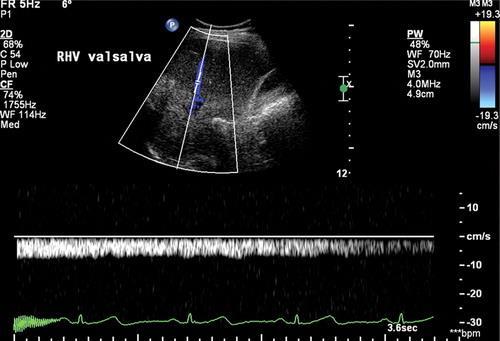 (a) Hình ảnh Duplex Doppler của tĩnh mạch gan giữa, thu được ở bệnh nhân với xơ gan, cho thấy một dạng sóng đơn phase thuận chiều. Trên màn hình Doppler màu, có liên quan đến dịch cổ trướng trước gan.