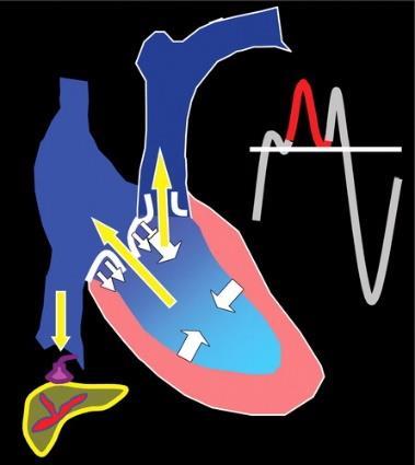 Figure 12 Diagrams of severe tricuspid regurgitation and the resulting abnormal waveform. White arrows = wall motion, yellow arrows = blood flow.