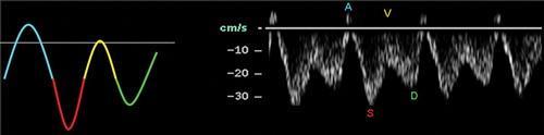 The extent of tricuspid regurgitation will obviously influence the morphology of the spectral waveform, which is graded as types 1, 2, and 3 (Fig 13).