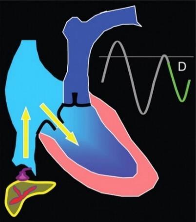Figure 4 Diagrams of blood flow through the right side of the heart and its influence on the spectral Doppler waveform.