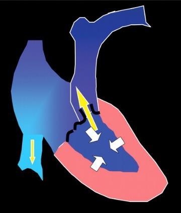 (b) With the pulmonic valve closed, the ventricular pressure increases before ejection of blood into the pulmonary artery.