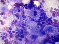 & What s your cytological diagnosis?