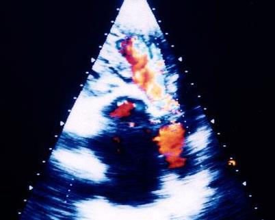A B Mặt cắt 3 buồng từ mỏm : Độ lan của dòng hở van động mạch chủ vượt quá