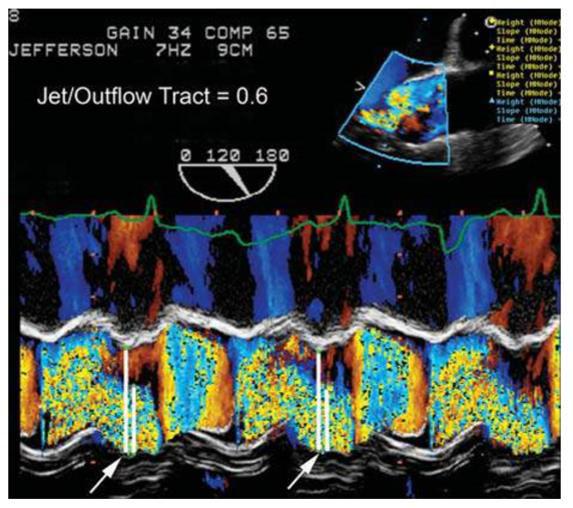 Color M-mode assessment of aortic regurgitation TL: Cohen IS.