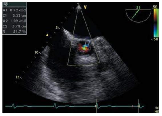 The jet area/left ventricular outflow tract area TL: Cohen IS.