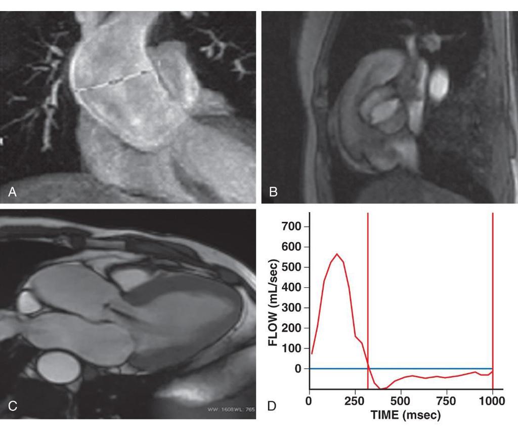 Hình ảnh cộng hưởng từ tim của bệnh van ĐMC 2 mảnh: hở van ĐMC và dãn ĐMC lên C: Balance SSFP image. Oblique axial LV inflow-outflow view, showing grade 2 AR.
