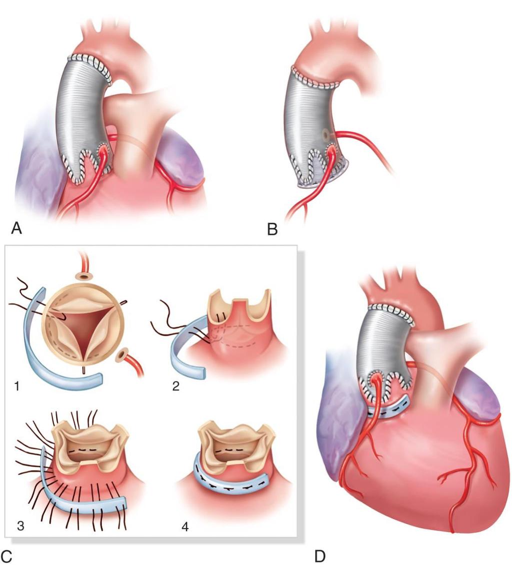Phẫu thuật hở van ĐMC do dãn gốc ĐMC Fig 68-21 A: remodeling of the aortic root with replacement of all three aortic sinuses.