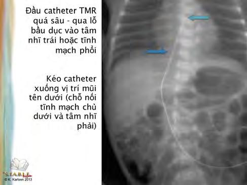 catheter slide 12