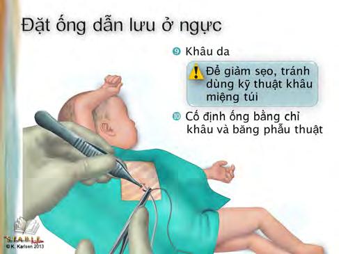 Chương trình S.T.A.B.L.E - Sách hướng dẫn học viên Hút khí màng phổi: Đặt ống dẫn lưu ở ngực 1-6 (tiếp theo) 11.