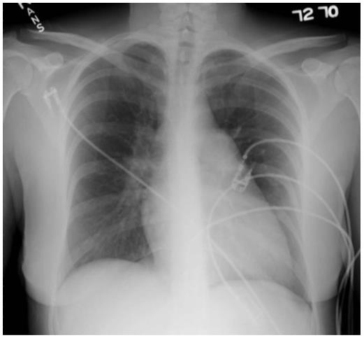 Phim x-quang ngực b/n TAĐMP TL: McLaughlin VV, Humbert M. Pulmonary Hypertension.