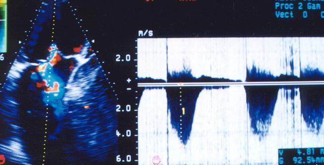 Siêu âm Doppler giúp đo ALĐMP Hình ảnh dòng hở van 3 lá Phổ Doppler liên tục dòng hở van 3 lá- Ap lực Động