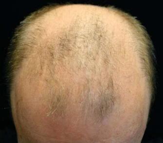 Rụng tóc lan toả: Là hiện tượng rụng tóc sinh lý, xảy ra ở hơn 50% nam giới > 50 tuổi và hơn 50% nữ giới > 80 tuổi.