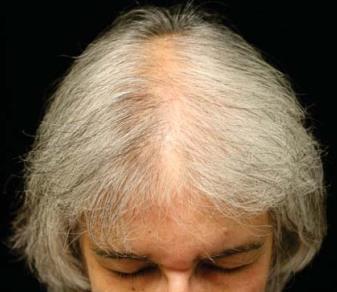 Nghiệm pháp kéo tóc thường bình thường hoặc chỉ kéo ra được một vài sợi tóc.
