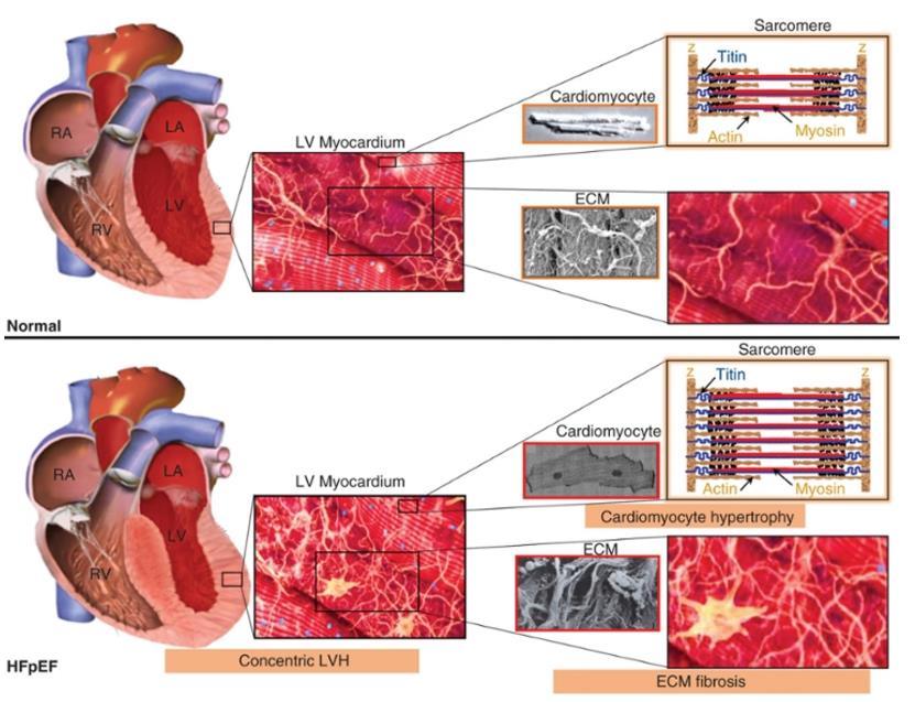 Ventricular, cellular, extracellular matrix and molecular structural changes in patients with HFpEF Fig 26-3 ECM: extracellular
