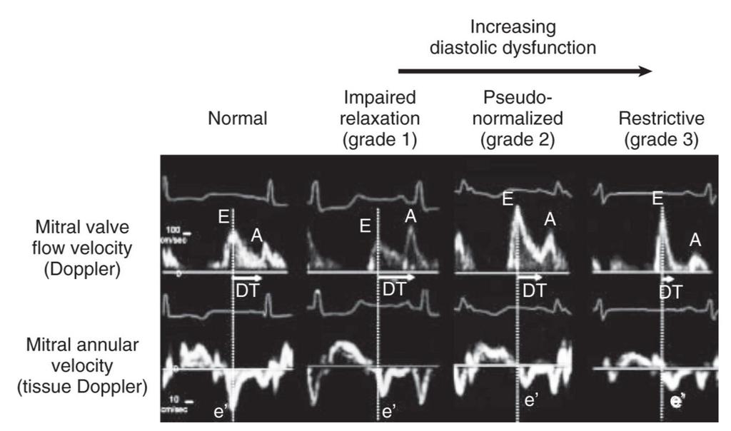 Evaluation of diastolic function based on LV filling dynamics by
