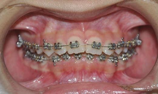022 lên các răng hàm lớn thứ nhất hàm trên và hàm dưới.