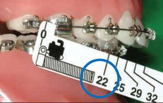 52 - Lắp khí cụ Forsus: + Cách lựa chọn thanh đẩy như sau: Bệnh nhân cắn ở tư thế khớp cắn trung tâm, đo từ rìa xa của ống headgear răng hàm lớn thứ nhất tới rìa xa mắc cài răng nanh hàm dưới.