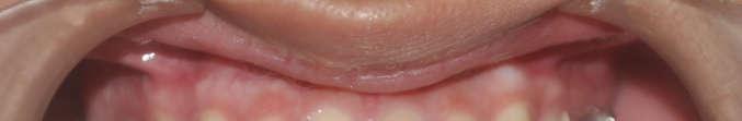 Alvetro khuyến cáo nên điều trị quá mức đến khi răng cửa
