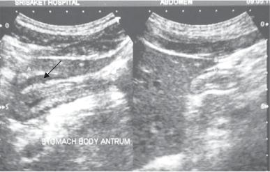 small antral ulcer µà ultrasound à «º ª µ (µ ß Ë 2) â ultrasound ««Àπ Õß æ Õ À æ «à «Àπ 6.
