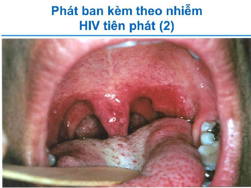 Slide 19 GIẢI THÍCH rằng đây là một ví dụ về viêm họng ở bệnh nhân nhiễm HIV cấp tính. GIẢI THÍCH rằng đau họng là một biểu hiện thường xuyên của nhiễm HIV cấp tính.