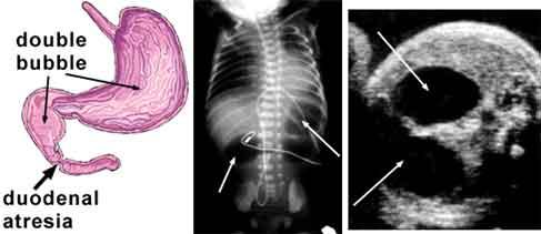 4. Hẹp tá tràng (duodenal atresia): Chít hẹp ở một một đọan của tá tràng. Tắt ruột non, hay teo hổng tràng là thường gặp nhất, tần xuất từ 1/5.000 