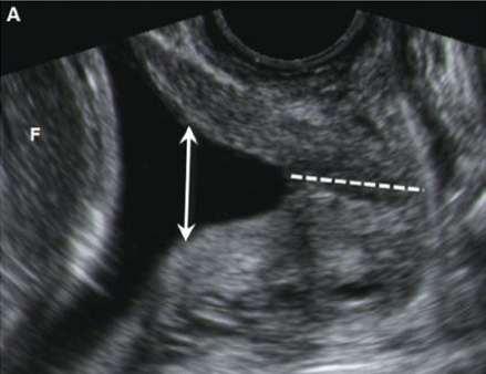 Shortened cervix by US and MRI.