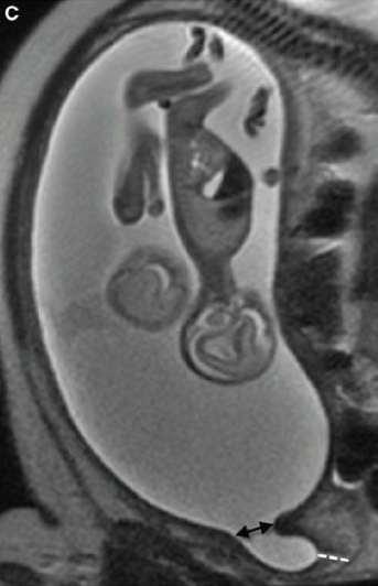 5 cm with funneling cervix, with walls of funnel in a Y-shaped configuration. F is fetus.