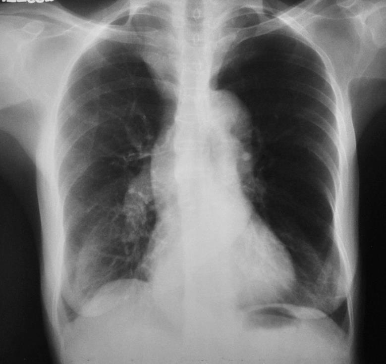 Tăng áp lực động mạch phổi type trước mao mạch (Suy hô hấp