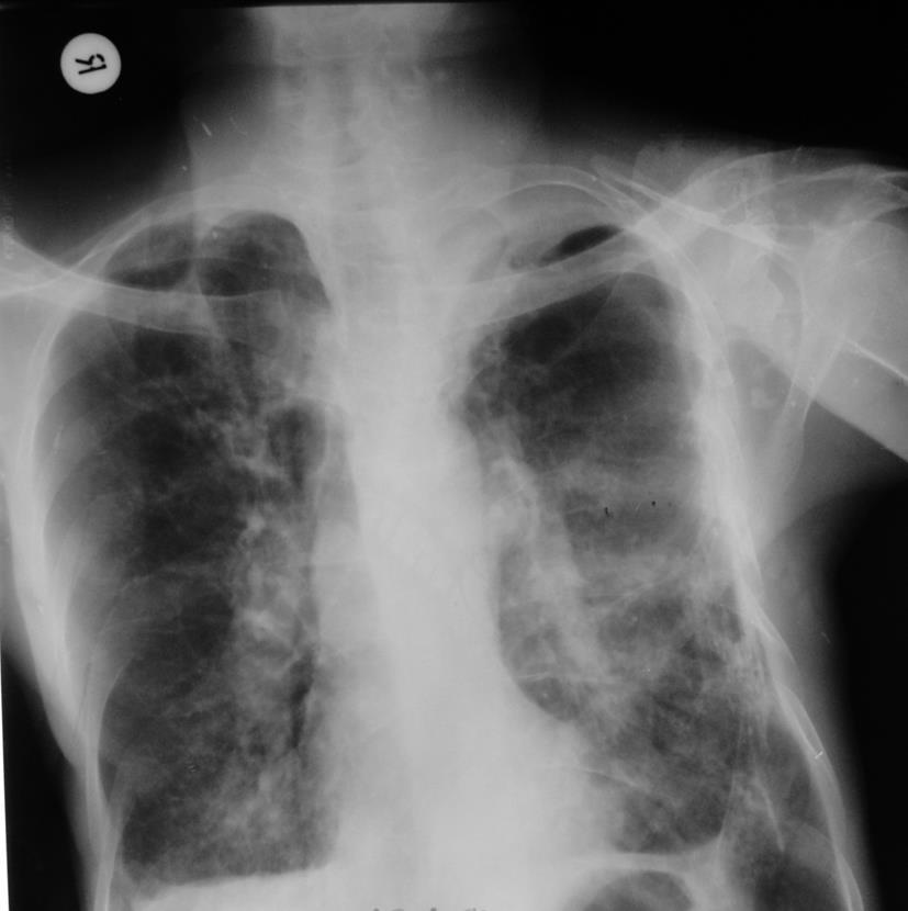 Tăng áp lực động mạch phổi trên bệnh khí