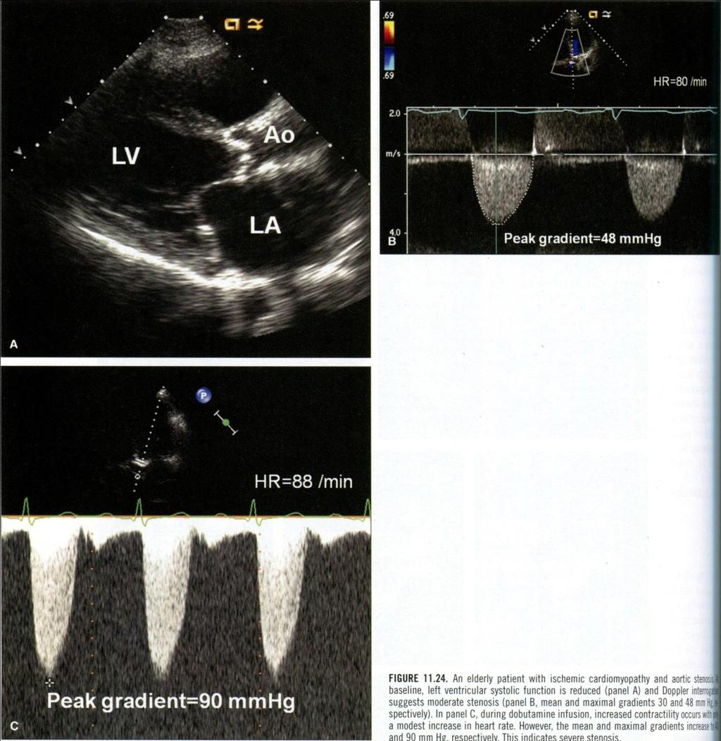 Siêu âm tim bệnh nhân hẹp van ĐMC kèm bệnh cơ tim thiếu máu cục bộ A: mặt cắt trục dọc, PXTM