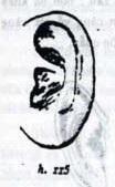 Loại tai này có Nhĩ căn lớn rộng chắc nên ngƣời ta có cảm giác tai dính hẳn vào khuôn mặt. Do đó mới có tên gọi là Niêm não nhĩ (h115).