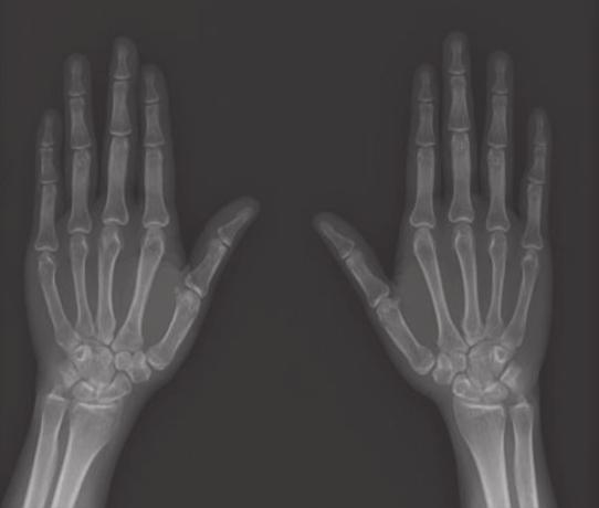 (Postero-anterior) (A) «Rhuematiod Arthritis (B) Ÿ Õª