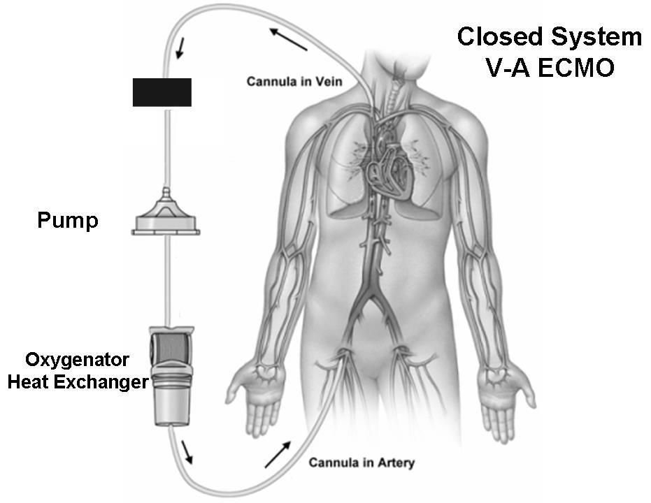 Bladder Catheter đường ra tĩnh mạch Bơm ECMO VA: hệi II thống kín Circuit