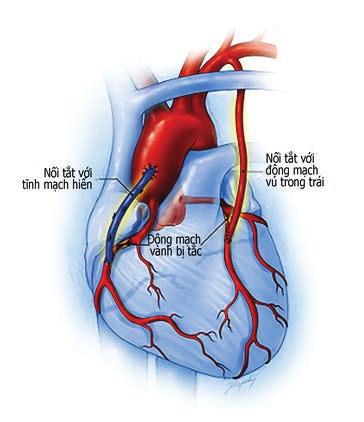 loại phóng thích thuốc chậm giúp giữ cho các động mạch luôn mở. Phẫu thuật nối tắt động mạch vành.