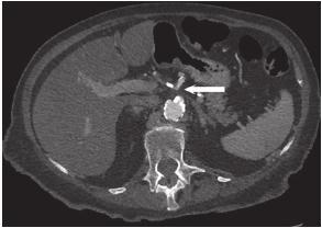 Case Studies in Abdominal and Pelvic Imaging Chẩn đoán đau mạch mạc treo thứ phát do hẹp xơ vữa nặng động mạch