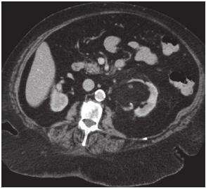 Bệnh nhân không có triệu chứng khác nên được chụp CT ngực, bụng và chậu tìm u nguyên phát (hình 1-4) Câu hỏi 1. Hình 1-4 cho thấy gì? 2. Chẩn đoán là gì?