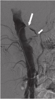 Case 91 275 Chụp mạch máu sau khi đặt stent (hình 10) cho thấy ĐMMTTT không còn hẹp (mũi tên