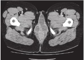 Case 92 Nữ, 17 tuổi, đau quanh hậu môn ngày càng nhiều, bệnh 1 tháng. Được chụp MDCT vùng chậu (Hình 1a và b).