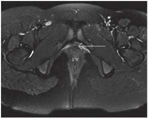 đây là dò liên cơ thắt, grade 2, có đường dò thứ phát. 3. Mũi tên ở Hình 3 chỉ tampon trong âm đạo. 4. Bệnh Crohn MRI là phương tiện hình ảnh được lựa chọn để đánh giá dò và áp xe quanh hậu môn.