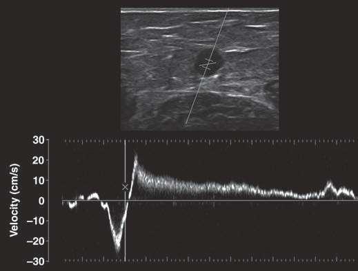 GSV SSV Đầu dò siêu âm cắt ngang mạch máu, nhưng tạo một góc hướng lên trên, giúp ta